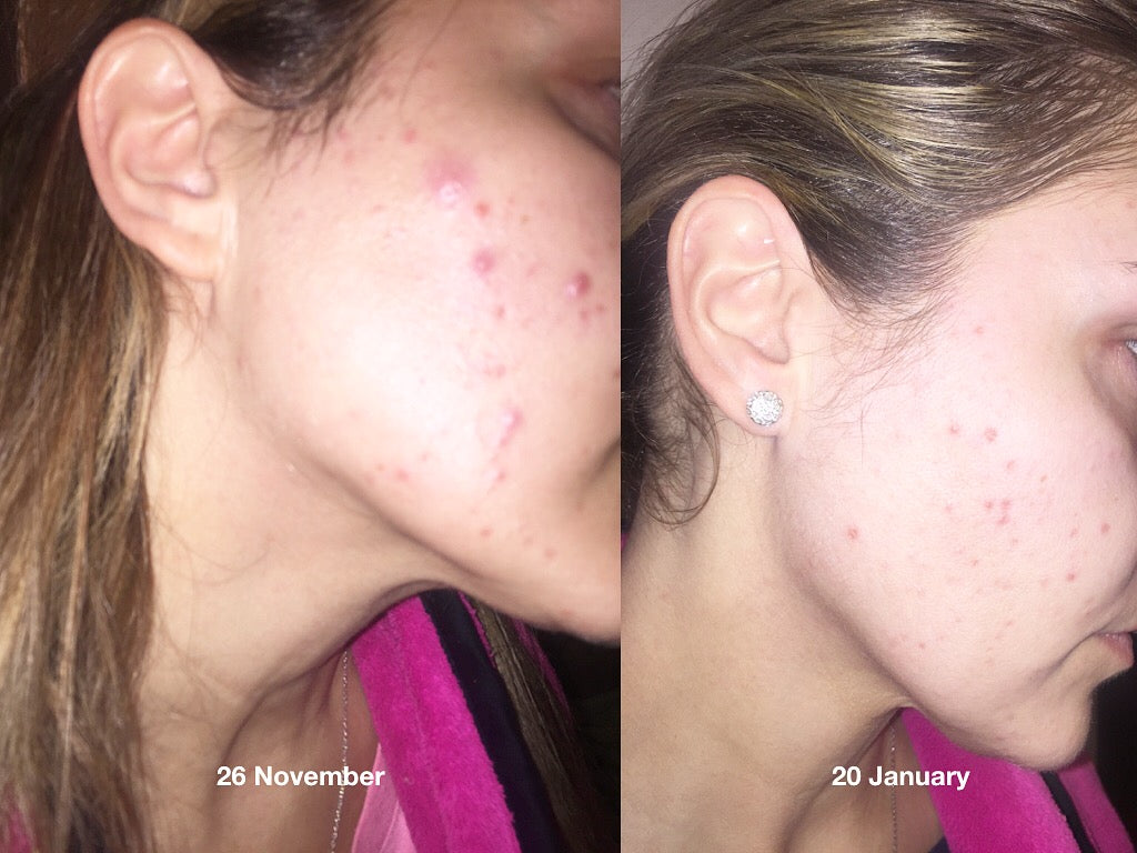 Blemish Skincare Routine - Mini